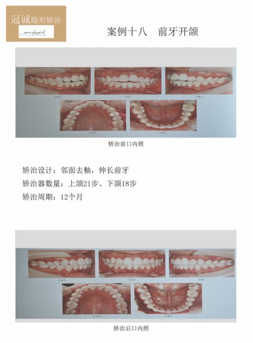 018案例、前牙开颌_1.jpg